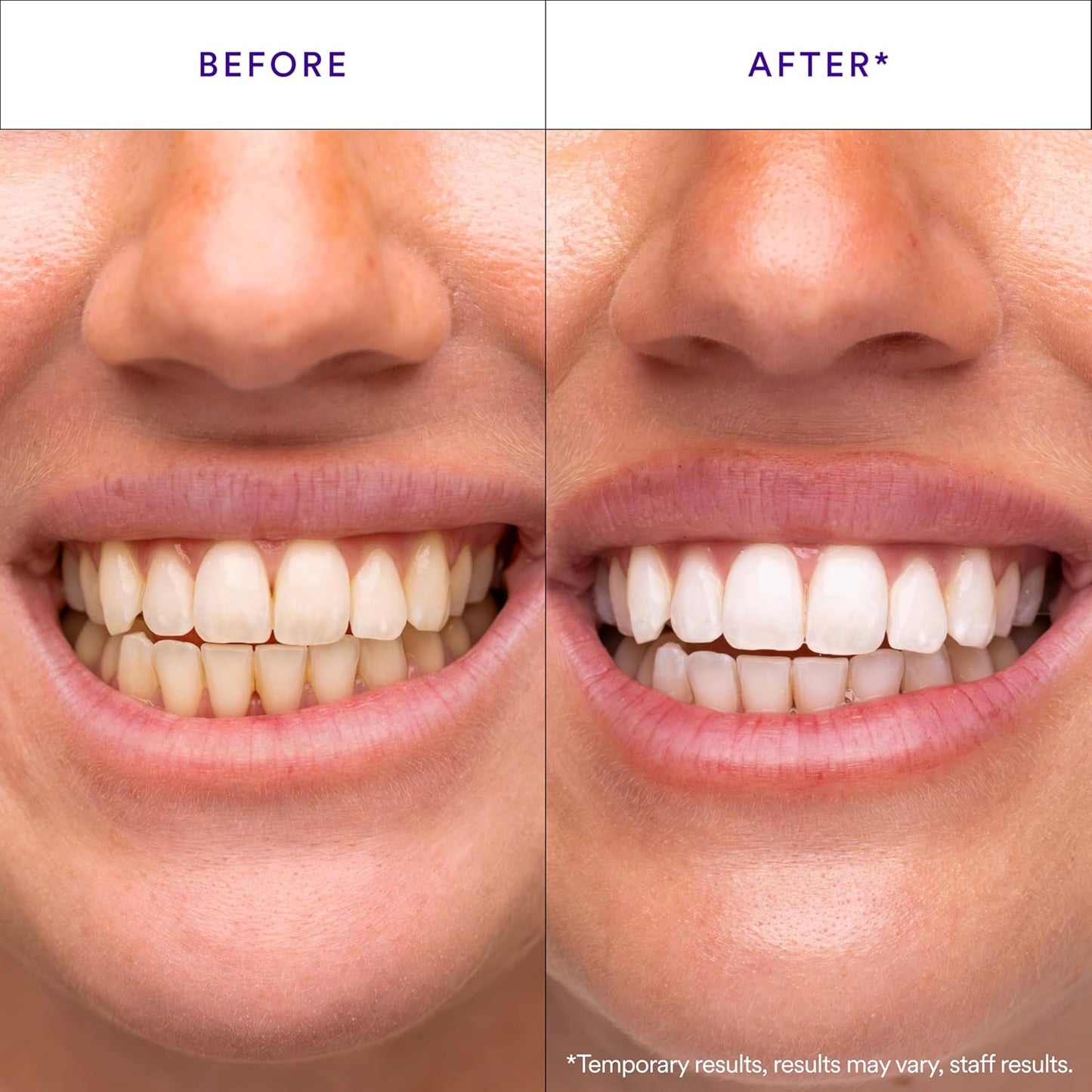 30-Minute Teeth Whitening Strips