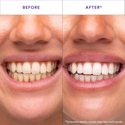 30-Minute Teeth Whitening Strips
